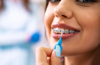 The Recovery Timeline After Getting Dental Implants